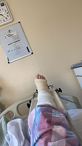 Broken ankle
